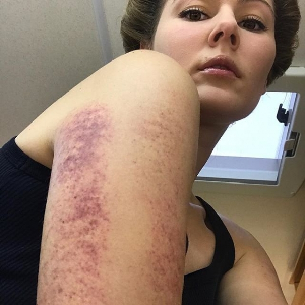 Мария Кожевникова шокировала подписчиков травмой руки