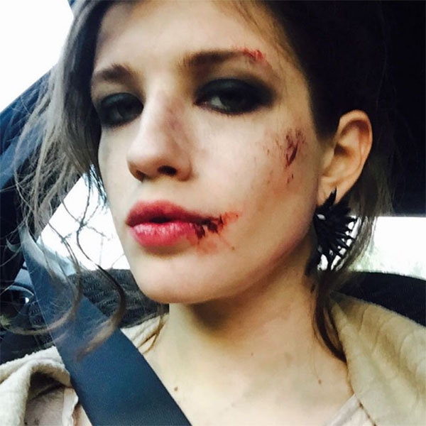 Анна Чиповская шокировала снимком разбитого лица