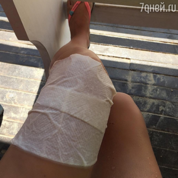 Лера Кудрявцева всерьез пострадала на отдыхе