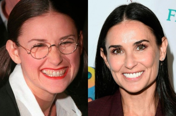 15 знаменитостей до и после реставрации зубов 