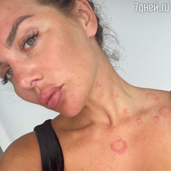 "I am a leopard": Anna Sedokova showed spots on her body from the disease