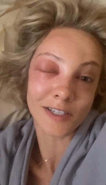 Polina Maksimova suffered from a bee sting